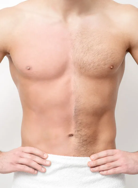 Chest-Hair-Removal-Treatment A strong man standing shirtless against a gray background showing the before and after results of chest hair removal treatment from Vida Integrative Health of Miami in Miami.